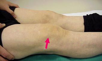 リウマチについて関節リウマチ、痛風整形外科やましな医院