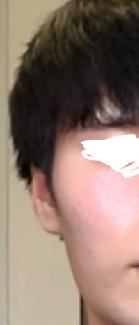 男性も小顔でイケメン度アップします！ジムに行っても顔だけ痩せない・そんな人に見てもらいたい症例です☆ - WOMクリニック銀座