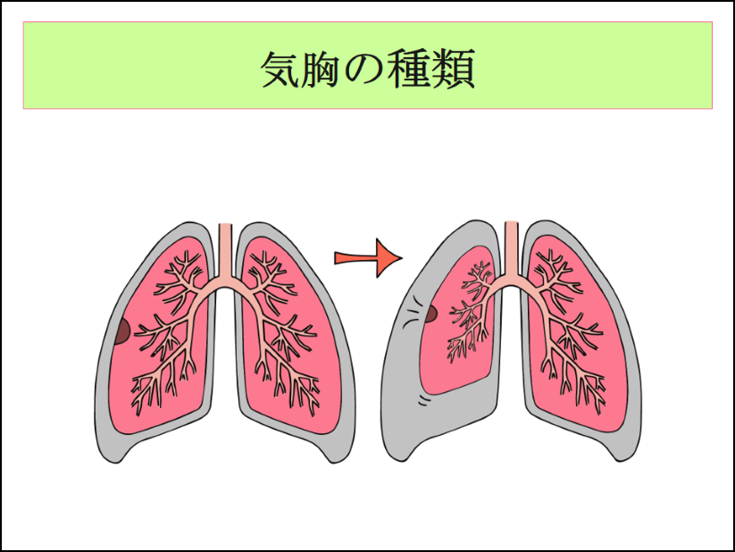 無気肺―肺葉性無気肺を中心にmedicina 41巻12号医書.jp
