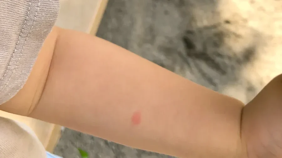 虫刺されによる紫のあざが・原因・治し方は？ イシャチョク