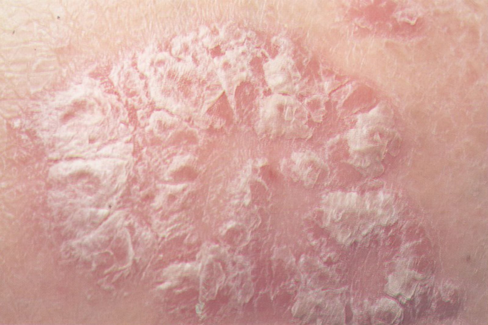 乾癬初期症狀有哪些？乾癬症狀6類型：不同病徵不同療程- 楊永榮早洩中醫推薦