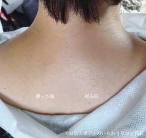 もう背中の脱毛しなくてもいいのでは！? ☆レーザー脱色☆ – 南青山 皮膚科スキンソリューションクリニック青山通り