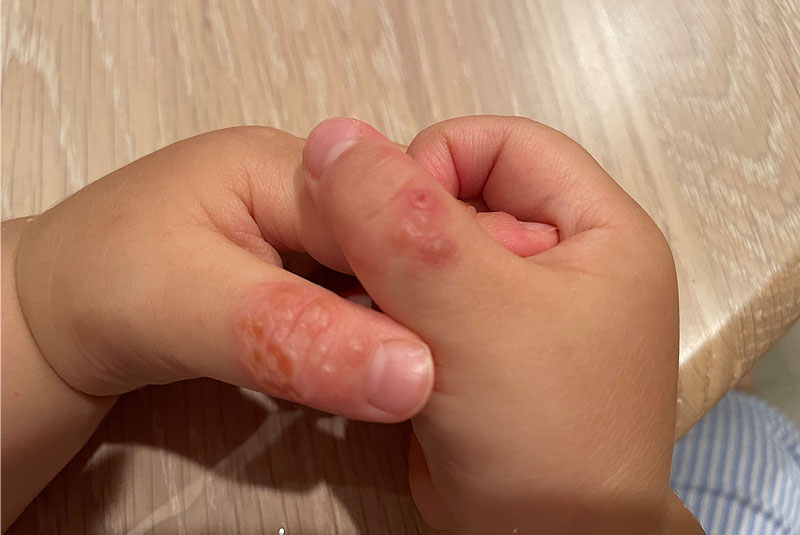 発疹を伴う病気 – まつだこどもクリニック