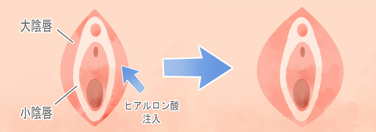 大陰唇形成 - 突出したりしわくちゃなクッションをぷっくりとした形に改善 - 韓国 SH Clinic