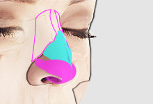 斜鼻、曲がった鼻の手術ってどんな流れ？術前相談〜術後１週間を公開