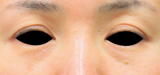 症例写真「オリジナル埋没術」 術前 1ヶ月三重まぶたに悩む女性 -麹町皮ふ科・形成外科クリニック市ヶ谷 半蔵門 永田町 千代田区