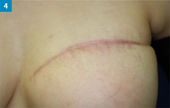 術後にテープを貼って意味がある？学会記録学術情報医療関係者向けニチバン株式会社：製品情報サイト