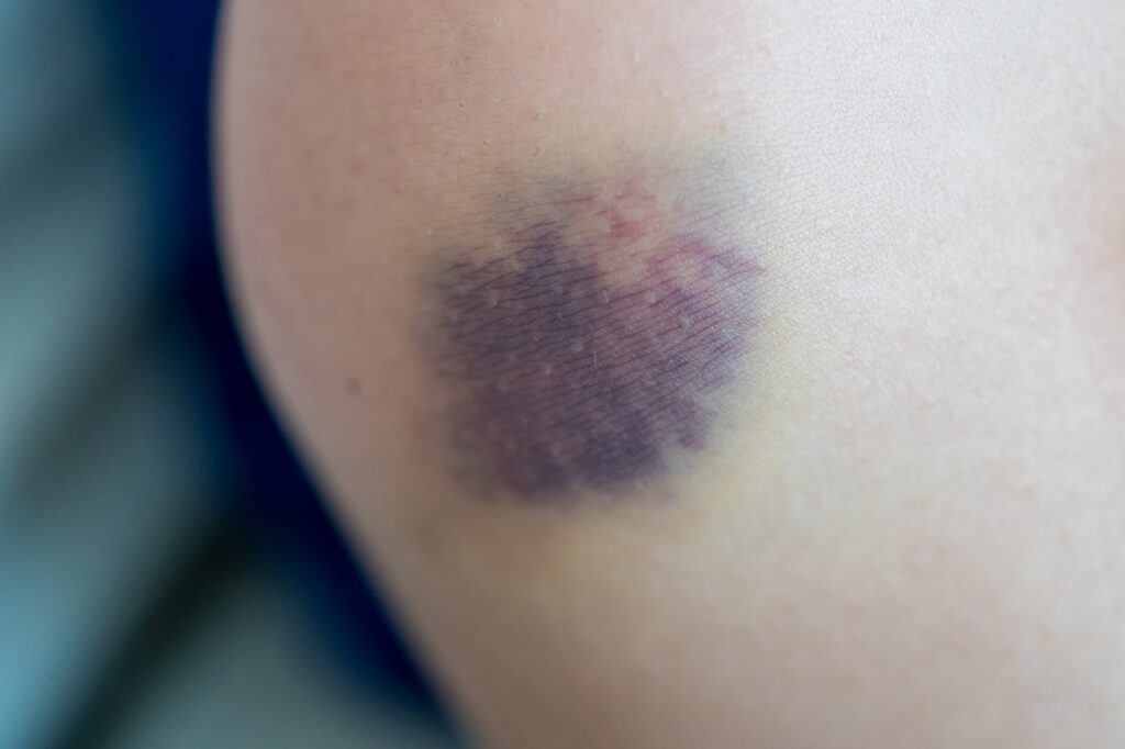 保健師ブログ 7月号 採血時の内出血健診システム・健康管理システム開発の株式会社アルファインターナショナル