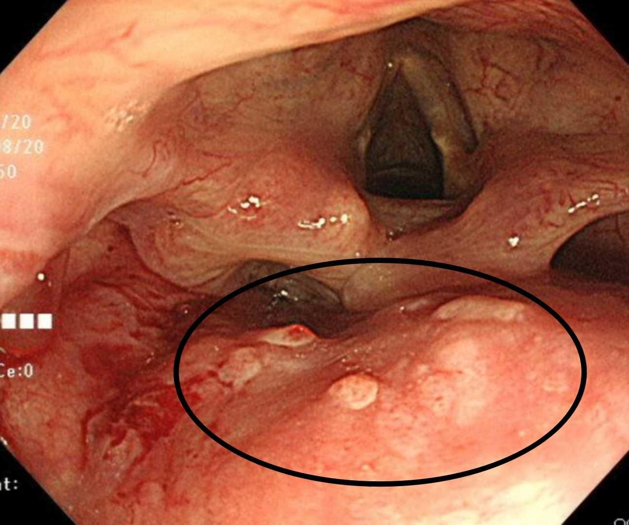 鼻の下 人中 の粉瘤症例 56歳男性 Y様あすなろクリニック