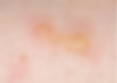 虫刺され ダニに刺された！症状や対処法のポイントは？－ダイコクライフスタイル