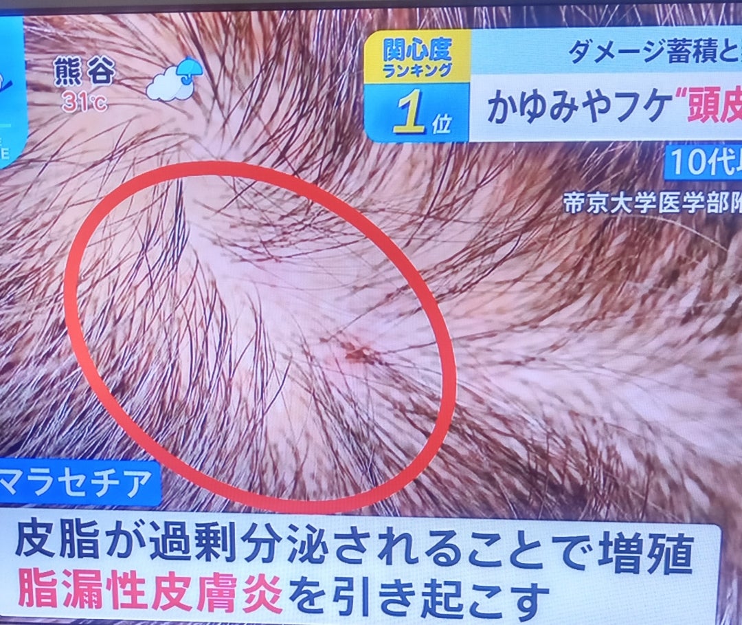 頭皮に湿疹・かさぶた・かゆみなど炎症ができる原因と対処法あさ美皮フ科亀戸駅前