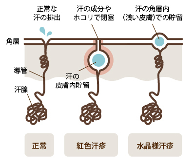 汗あれ・あせもの症状・予防法・治療法皮膚・爪・髪の病気All About