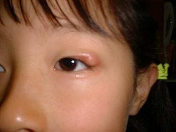 子供の目が腫れている！まぶたが赤い原因と対処法は？ - こそだてハック