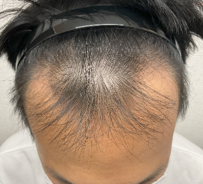 18歳女です。 - 分け目が薄いのがとても気になります。特に前髪部分です。ど- Yahoo!知恵袋