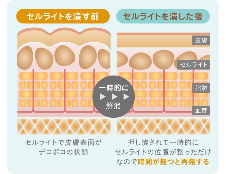 二の腕のセルライトはどう解消する？すっきり美腕への近道を紹介 - 銀座・名古屋・心斎橋の美肌治療は椿クリニック