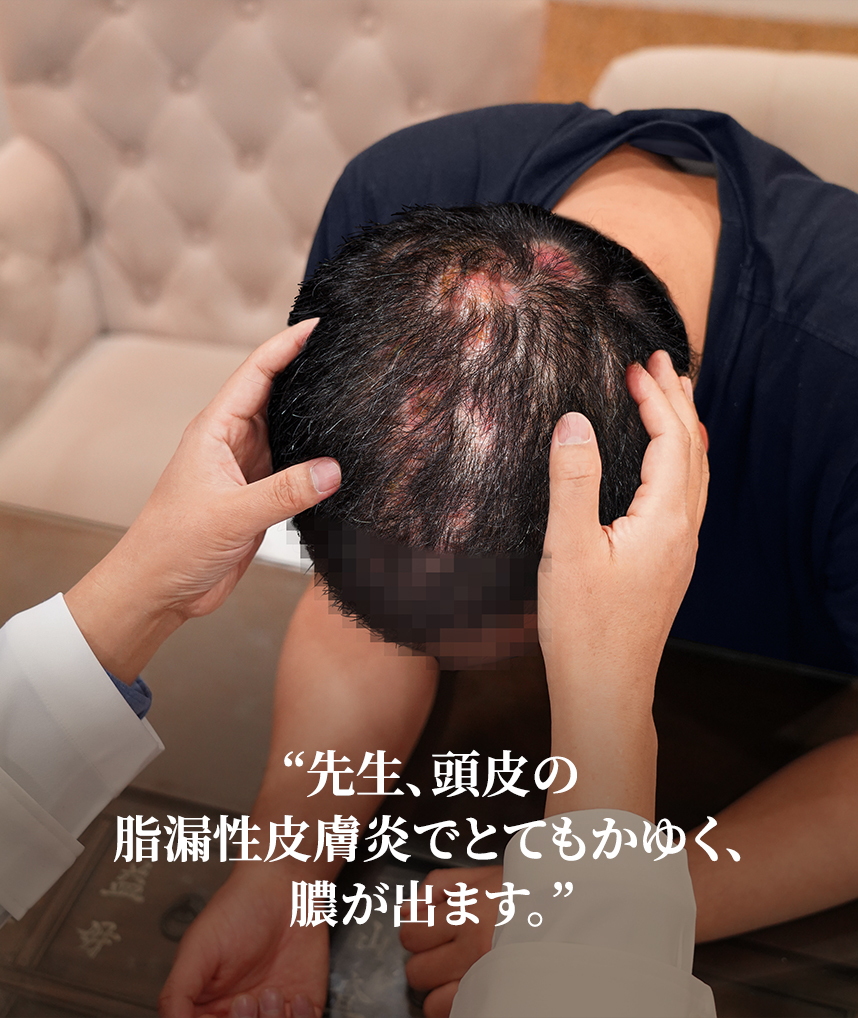 脂漏性皮膚炎とは?特徴や原因、AGAとの関係と治療法についても解説 公式 薄毛・抜け毛治療ならAGAスキンクリニック Aスキ
