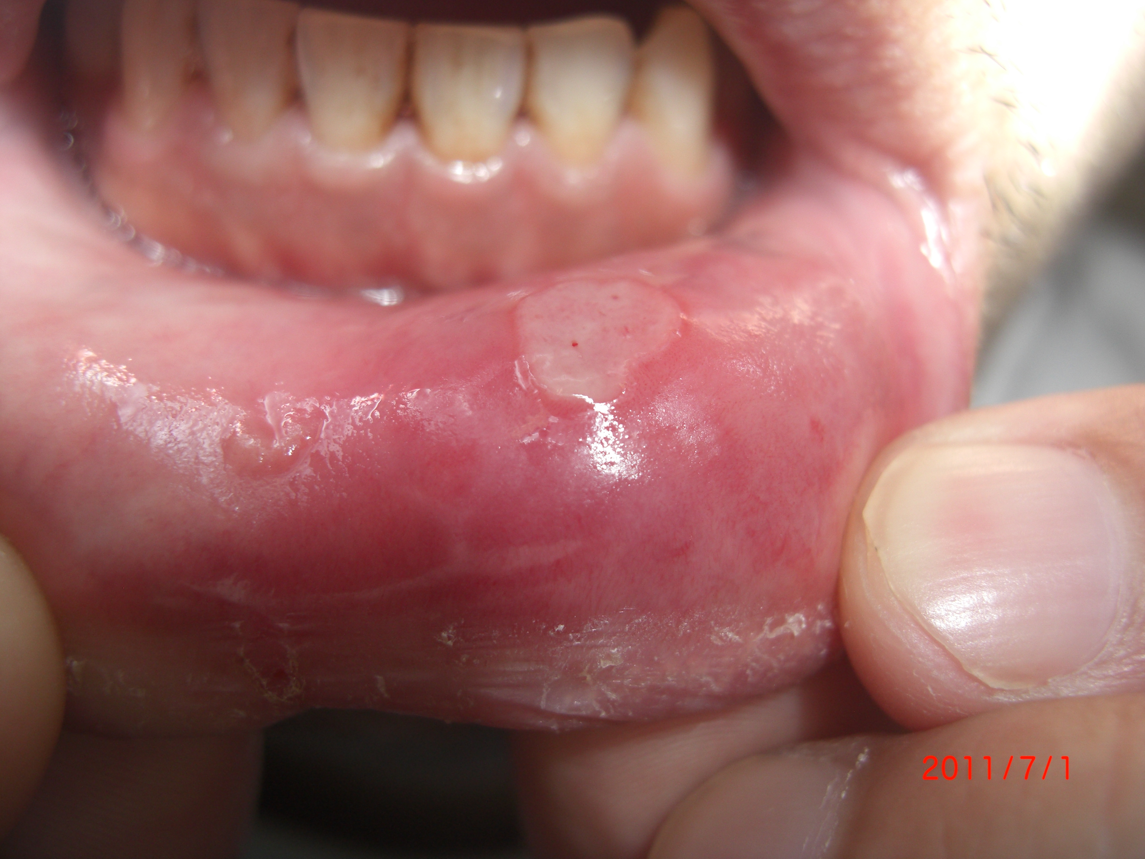 口の中の腫瘍 - 歯とお口のことなら何でもわかる テーマパーク8020