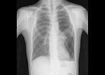 胸部CTで肺野の背側に認める限局的結節、胸膜肥厚、限局性無気肺、結節状無気肺 nodular atelectasis