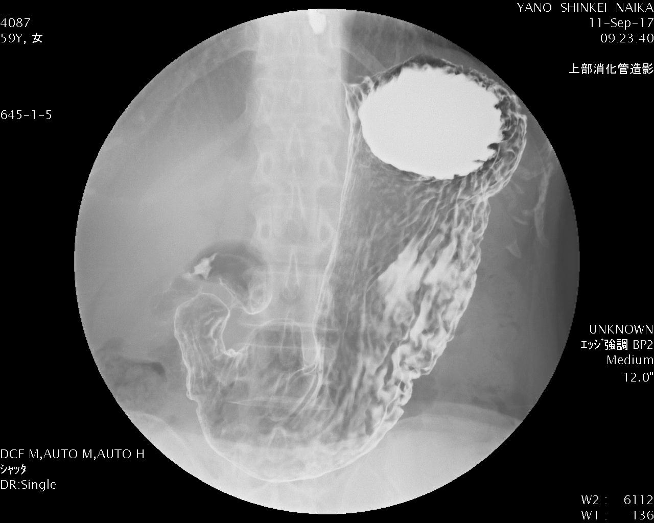 胃バリウム検査 画像一覧症例・事例矢野医院射水市の内科・消化器内科・神経内科
