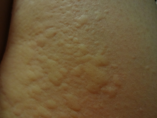 豊中市で急性じんましんを治療するなら千里中央花ふさ皮ふ科