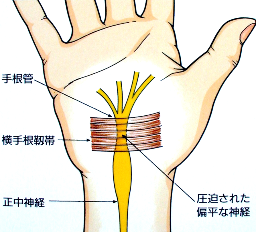 手がしびれる？手根管症候群かもしれません