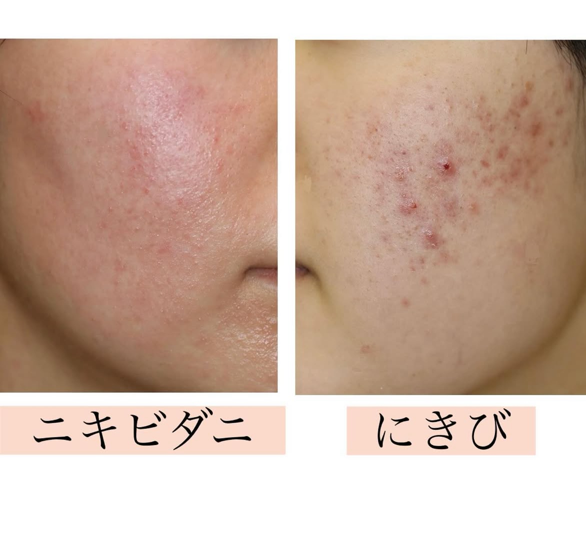 何百回でも言うけど、 顔のブツブツ 毛孔性角化症 は ピーリング→アゼライン酸→尿素クリーム 皮膚科で「30過ぎたら治るよ」って言われて、 何年もこの ブツブツと共に過ごしてたのに この組み合わせ韓クリのお姉さんに聞いて塗ってたら1週間でツルツルになった‼️ 今