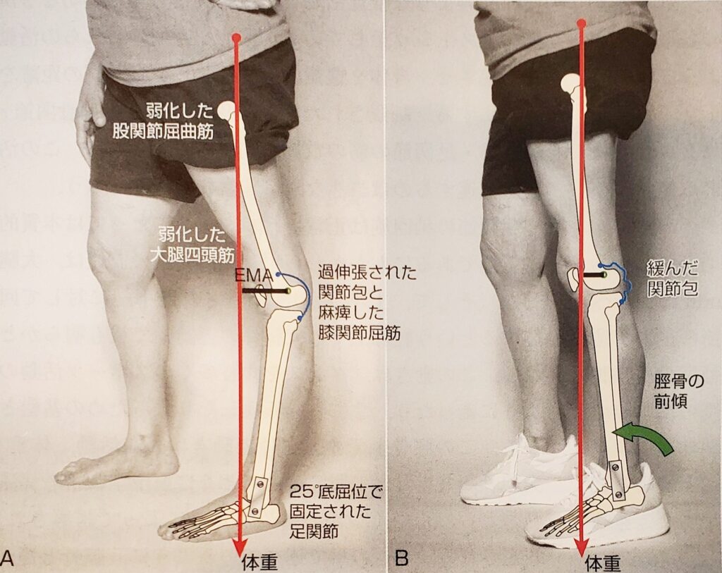 反張膝 治し方ストレッチ集