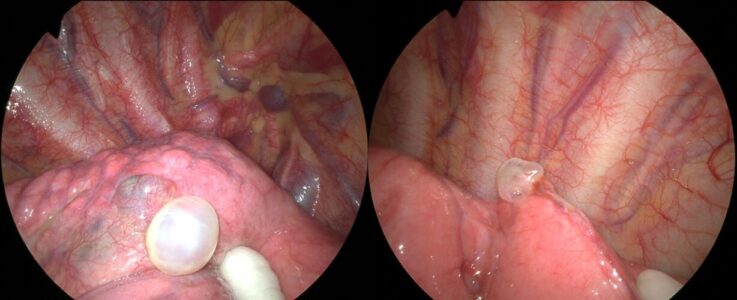 無気肺について横浜弘明寺呼吸器内科クリニック健康情報局