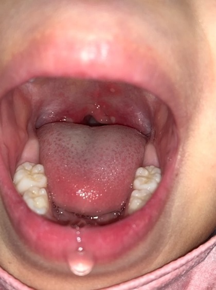 夏風邪のヘルパンギーナが増えています。たくゆう耳鼻咽喉科クリニック 院長ブログ