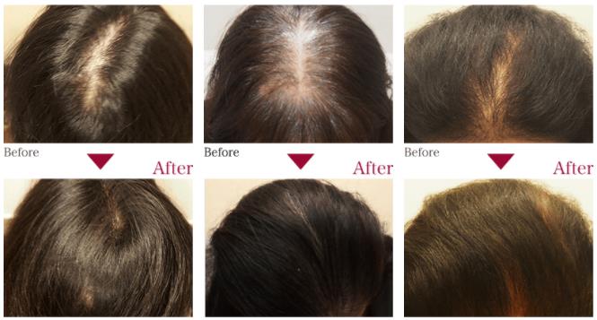 女性の髪の毛が細くなったと感じる原因と改善方法を紹介ベアAGAクリニック新宿で薄毛治療なら当クリニック