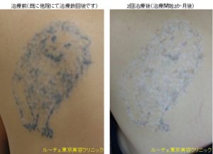 白斑、色素脱失でお困りの方に皮膚染色料のダドレスをお勧め！にしやまクリニックグループ！にしやま形成外科皮フ科クリニック、形成外科専門医:西山智広