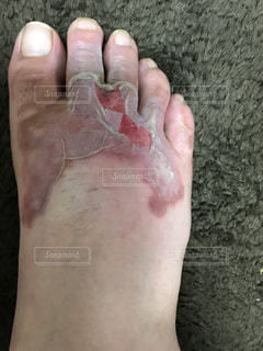 医者は足の死んだ皮膚を切りました。人間のかかとにひどい水ぶくれができた。男の足の濡れた血の痛みを伴う皮膚の写真素材・画像素材 Image111878591
