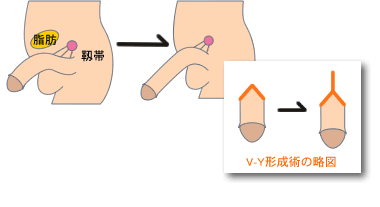 包茎手術・長茎術・亀頭増大術｜川崎中央クリニック｜川崎駅東口2分