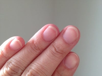 肥厚爪ケア・原因と予防法ドクターネイル爪革命®