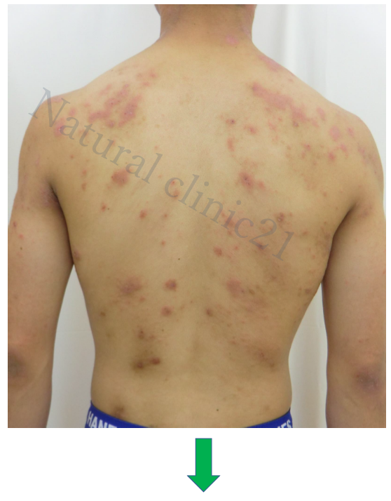 重症アトピーが治まって肌の色も正常に！ 入院期間：2016年6月～8月：症例29アトピー脱ステロイド専門入院自然療法『ナチュラルクリニック21』