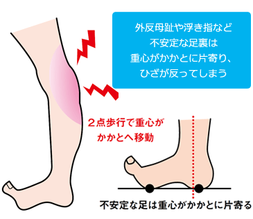 医師監修 X脚 外反膝 の原因とは？O脚との違いやリスク、治療法を解説ひざ関節の痛み解消ナビ