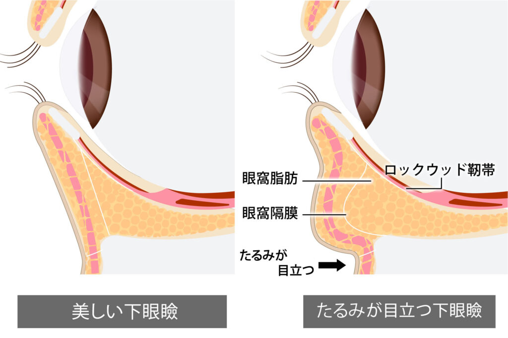 よく寝てるのにクマがひどい原因は？ 睡眠不足のクマを消す方法・治し方横浜市鶴見の形成・美容外科 エムズクリニック