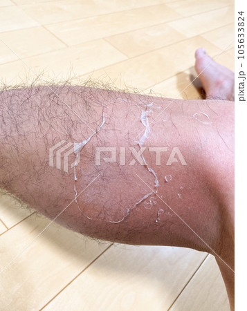 日焼けによる皮むけはむいてはいけない！ケアをしないとシミやくすみの原因に