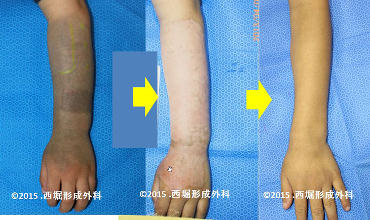 生後7か月児の異所性蒙古斑のレーザー治療シャルムクリニックBlog