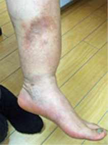 芸能人も悩むクインケ浮腫 血管性浮腫 とは？原因や治療法などを解説します