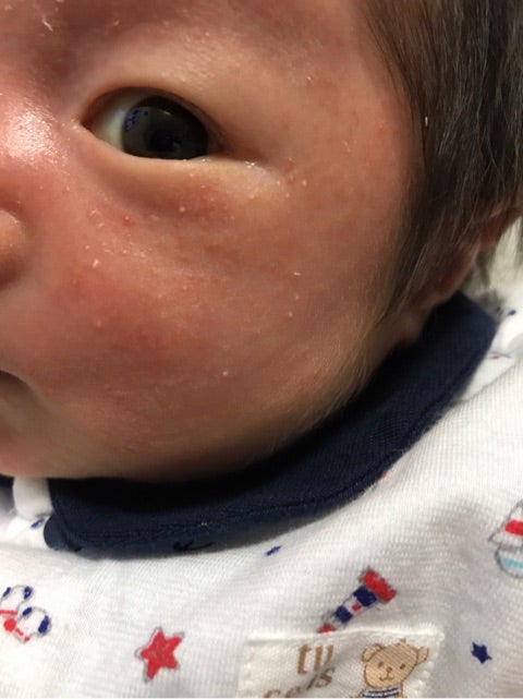 新生児ニキビ☆いつも心におひさま☆ ～0歳から始まったアトピーとの戦い～