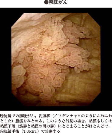 対象となる病気 膀胱がん診療紹介金沢医科大学 泌尿器科学