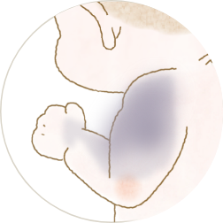 青あざの治療 〜異所性蒙古斑・太田母斑