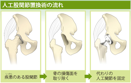 人工股関節手術 置換術 について石部基実クリニック