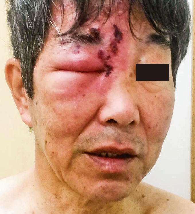 帯状疱疹・ヘルペスの原因はストレス？症状 痛み・かゆみ と治療法ことぶき皮ふ科クリニック