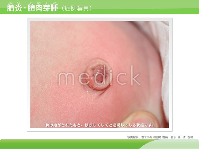 おへその中が赤い・かゆい・臭いのはなぜ？原因と対処方法を解説 - eo健康