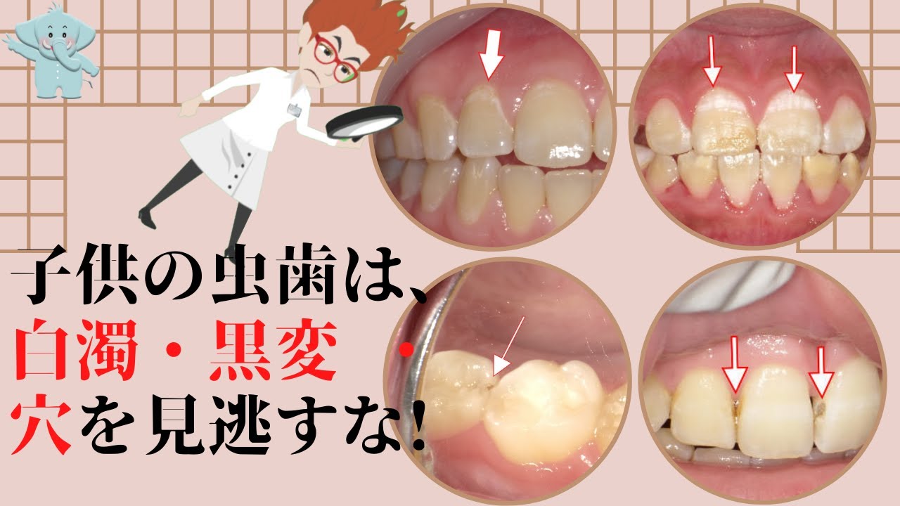乳歯は虫歯になりやすい？特徴とできやすい箇所、治療法と予防法