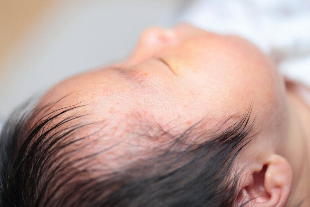 汗も野田市 小児科 千葉県 こどもの花粉症 こどもの漢方 喘息 アトピー性皮膚炎 アレルギー 結節性痒疹 たんぽぽこどもクリニック
