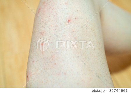 身上起丘疹，竟是高脂血症惹的祸_中国江苏网