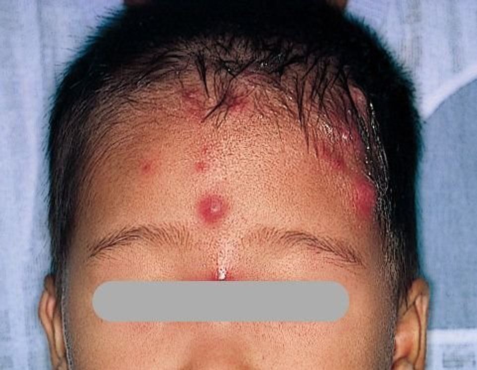 猛暑の皮膚トラブル「あせも」 - 南22条おとなとこどものクリニック 中央区南、幌南小学校前駅・東屯田通駅電停近く、内科・小児科